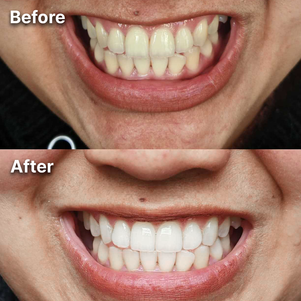 Purple Whitening Strips for a Brighter, Whiter Smile