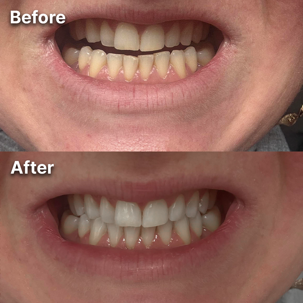 Purple Whitening Strips for a Brighter, Whiter Smile