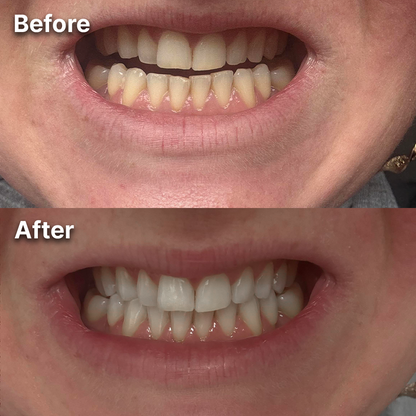 Purple Whitening Strips for a Brighter, Whiter Smile