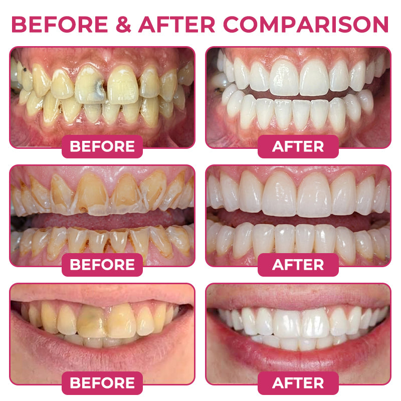 Rolimey®  Cavity-Repair Natural Enamel Filling Gel
