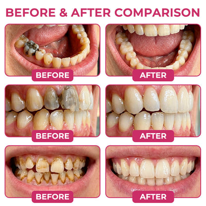 Rolimey®  Cavity-Repair Natural Enamel Filling Gel